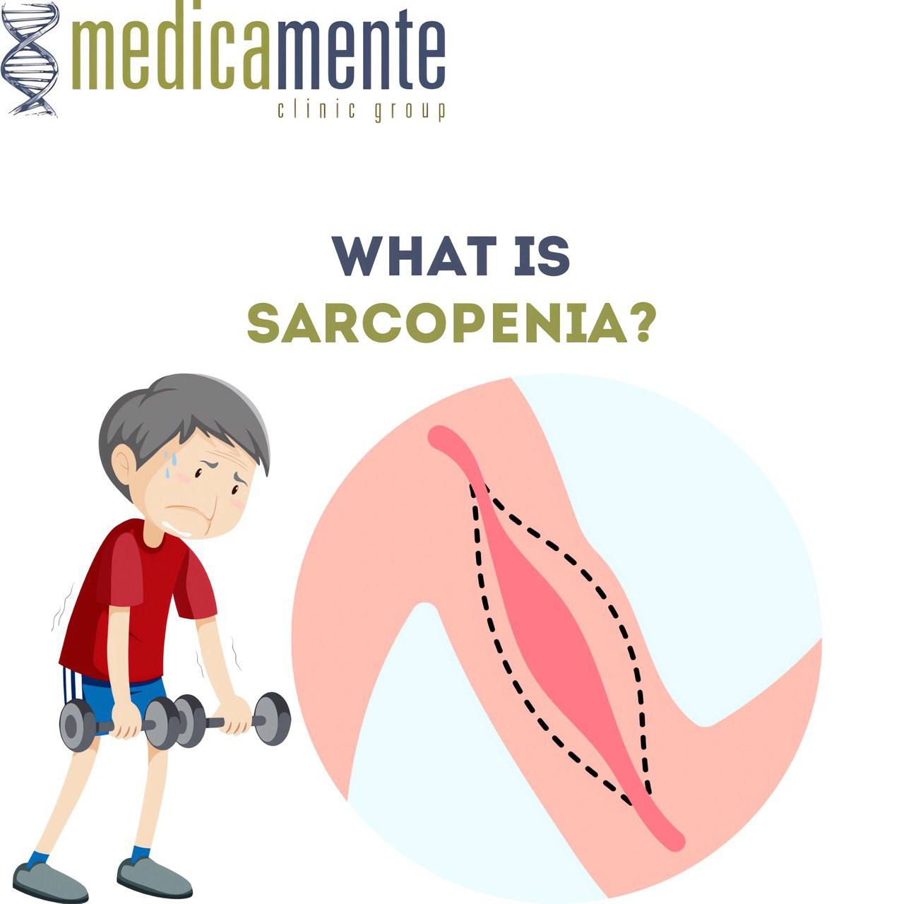 What is sarcopenia?